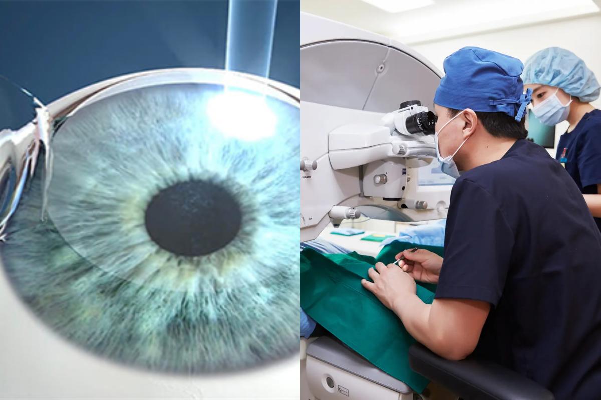Guide complet sur la chirurgie oculaire au laser en Corée | SMILE LASIK, SMILE PRO, LASEK