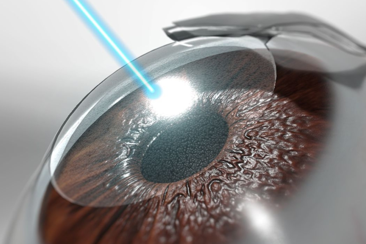 韓國 Lasik 與 Lasek 手術差異比較圖