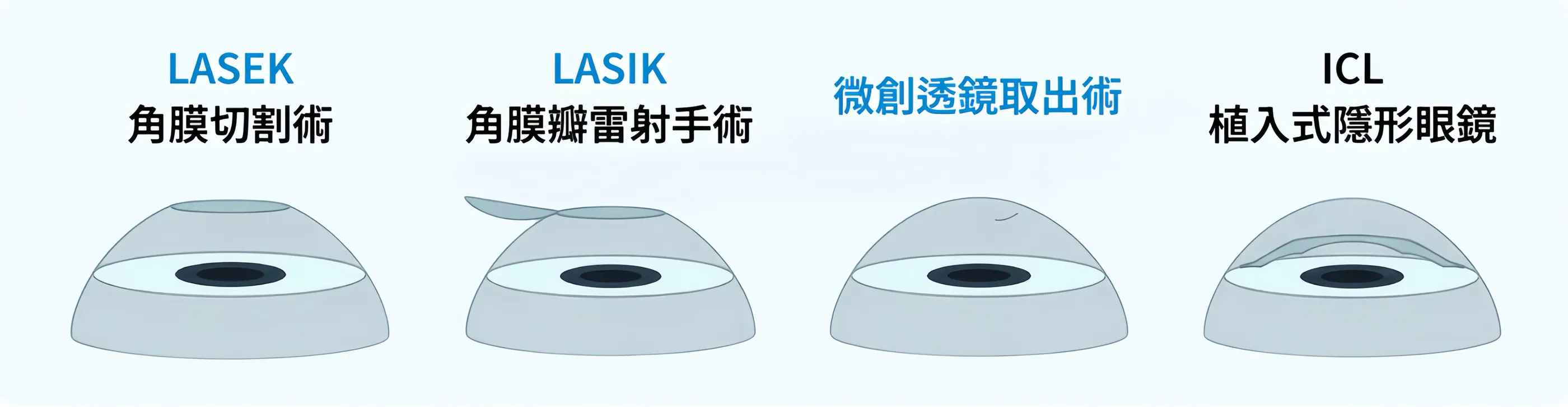2026 韓國近視雷射手術分類圖，說明角膜切削、全飛秒與 ICL 差異