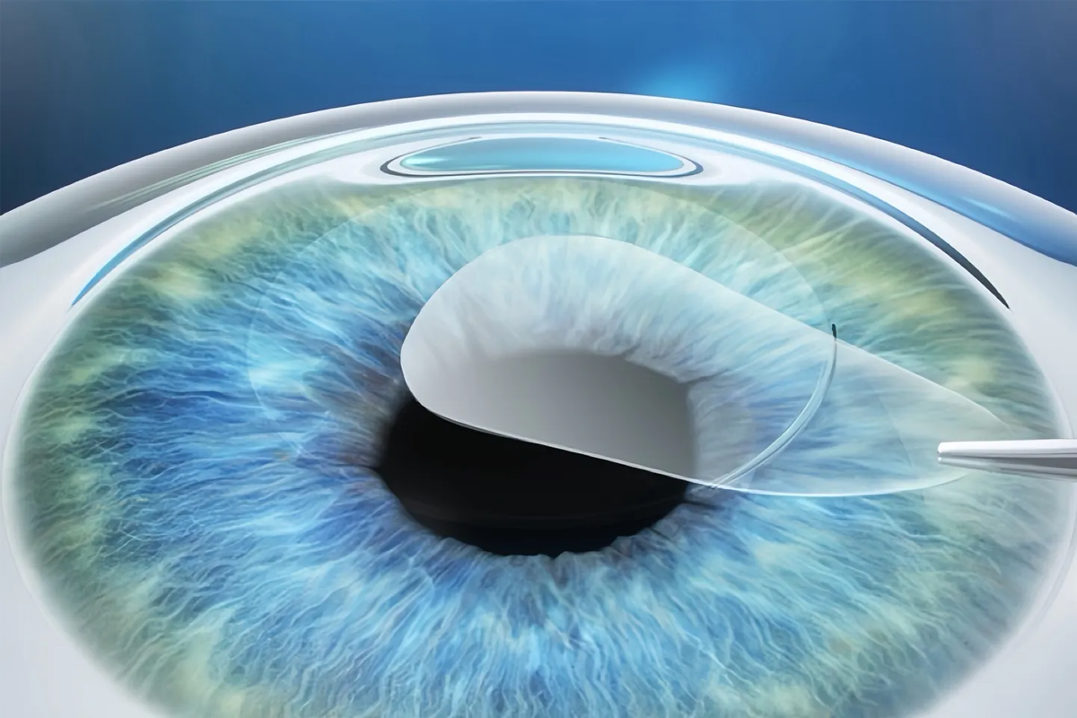 韓國眼科視力矯正手術差異示意圖，說明微創透鏡取出術原理