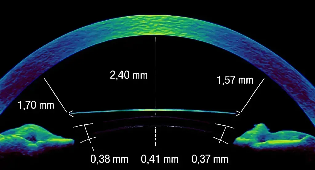 韓國 ICL 晶體植入手術示意圖