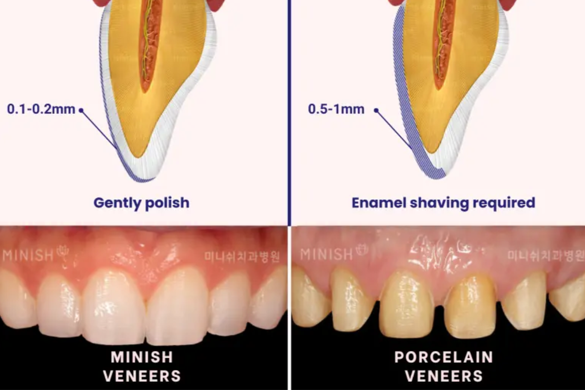 韓國牙科 韓國牙醫 韓國牙齒美白 韓國美白 韓國洗牙 韓國牙科診所 韓國牙齒美白價錢 收費比較 推薦牙科診所 陶瓷牙貼 箍牙 MINISH牙科