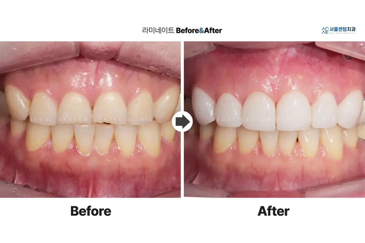 韓國牙科 韓國牙醫 韓國牙齒美白 韓國美白 韓國洗牙 韓國牙科診所 韓國牙齒美白價錢 收費比較 推薦牙科診所 陶瓷牙貼 箍牙 首爾CENTUM牙科醫院