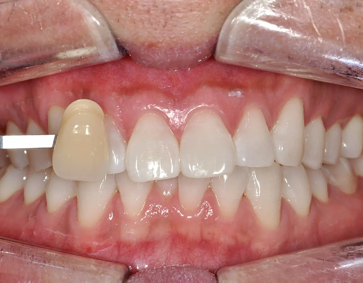 韓國牙科 韓國牙醫 韓國牙齒美白 韓國美白 韓國洗牙 韓國牙科診所 韓國牙齒美白價錢 收費比較 推薦牙科診所 陶瓷牙貼 箍牙 延世Uline牙科