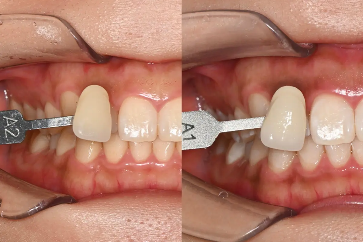 韓國牙科 韓國牙醫 韓國牙齒美白 韓國美白 韓國洗牙 韓國牙科診所 韓國牙齒美白價錢 收費比較 推薦牙科診所 陶瓷牙貼 箍牙 LE牙科