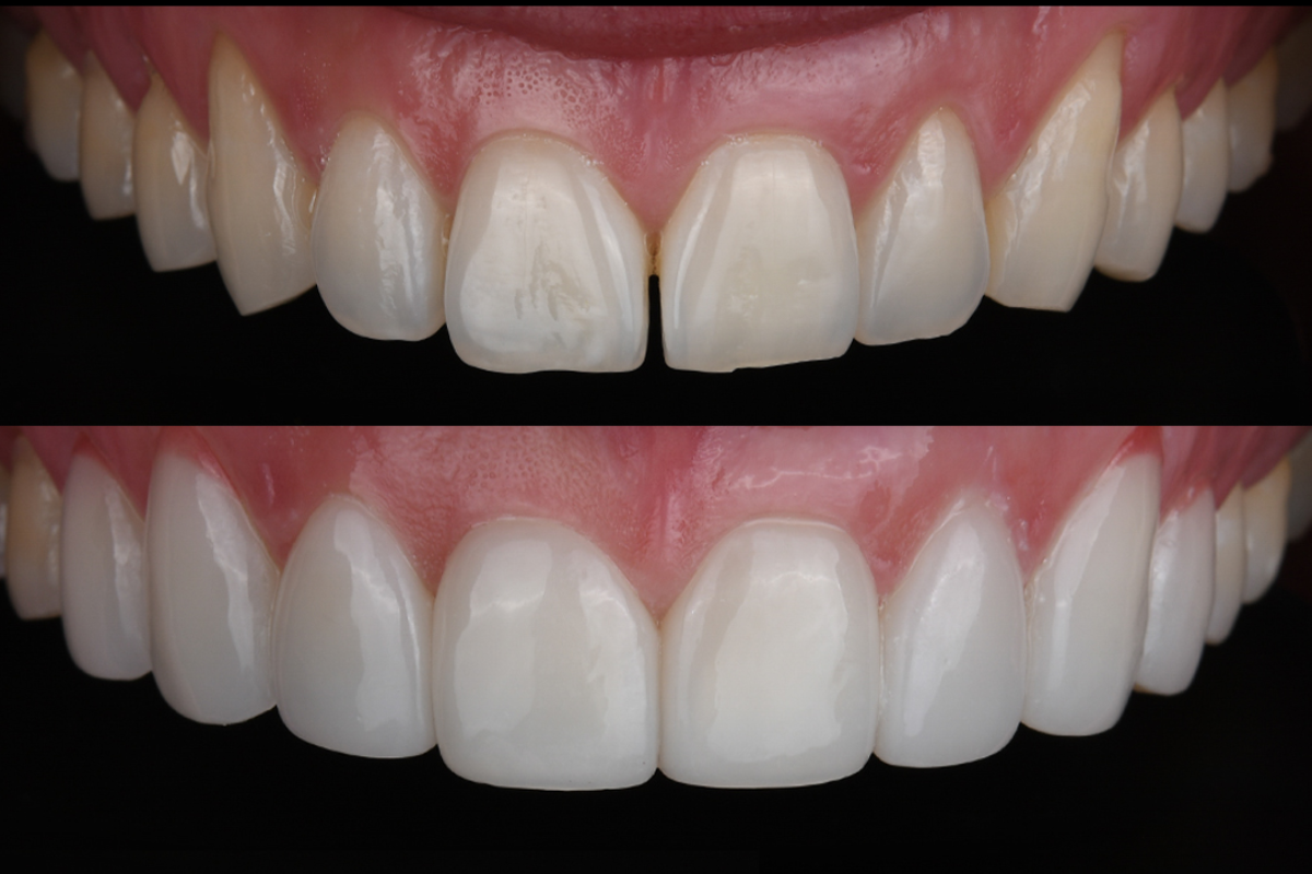 韓國牙科 韓國牙醫 韓國牙齒美白 韓國美白 韓國洗牙 韓國牙科診所 韓國牙齒美白價錢 收費比較 推薦牙科診所 陶瓷牙貼 箍牙 TU牙科