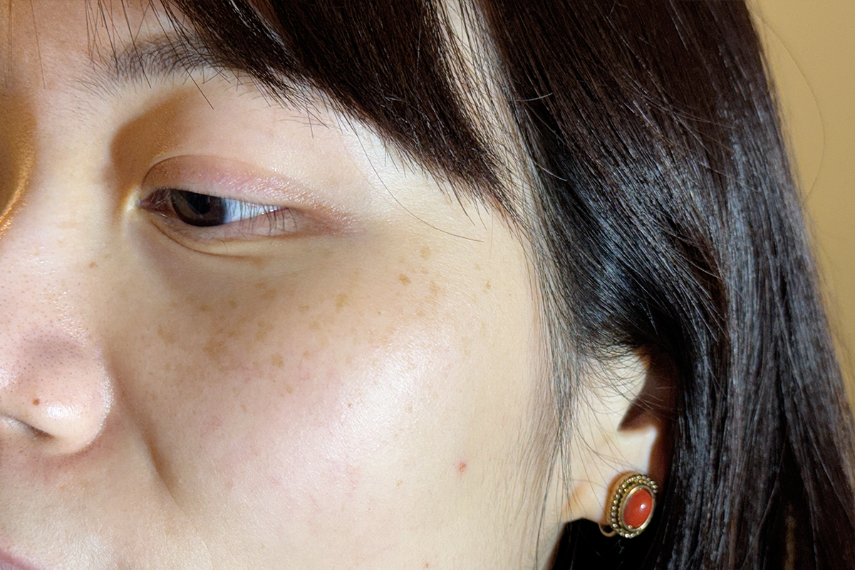 Close-up showing freckles and acne scars as major skin concerns for treatment.