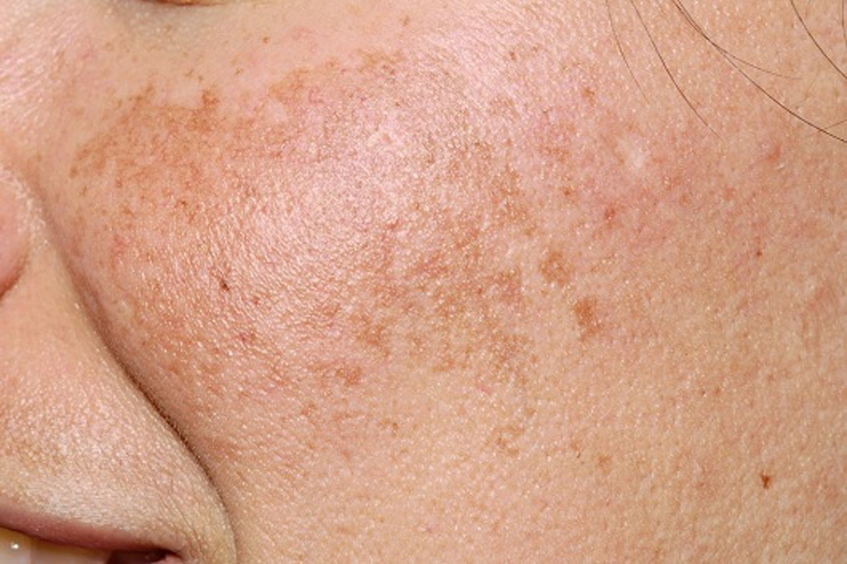 Image illustrating skin with melasma and hyperpigmentation characterized by blurred outlines.