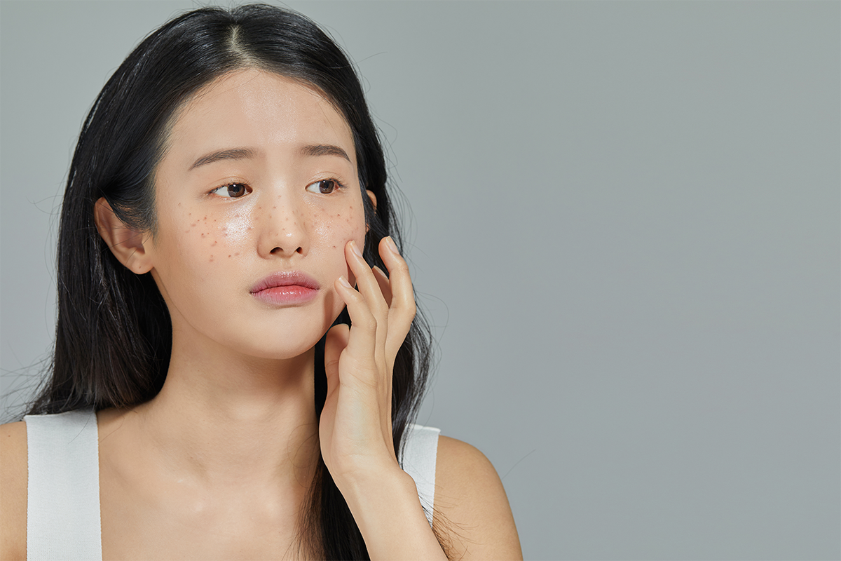 Close-up image showing dark facial blemishes caused by melanin pigmentation.