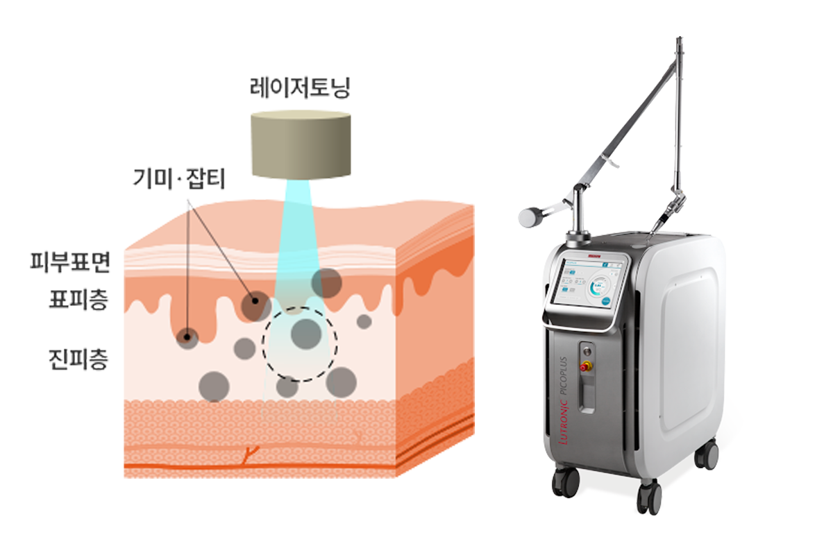 Diagram showing Picotoning procedure targeting deep skin melanin for treating melasma.