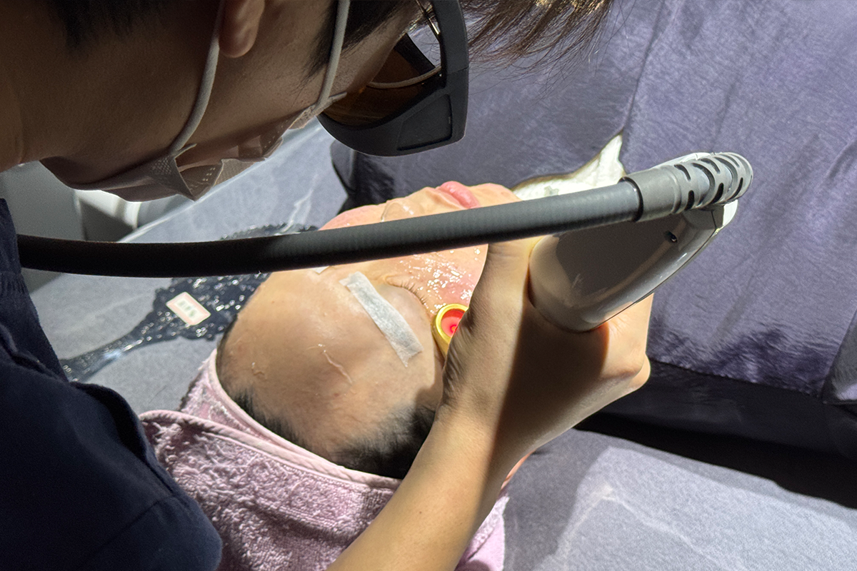 Gel application during Excel V Laser treatment to enhance pigmentation improvement.