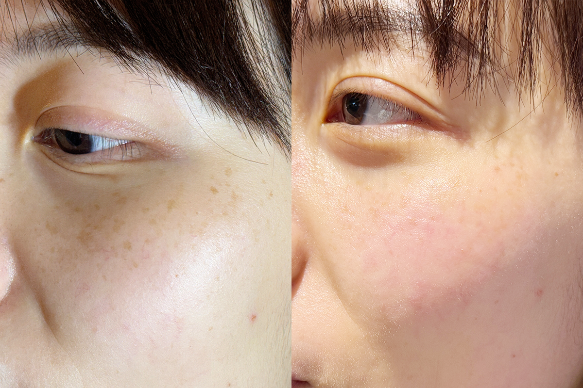 Photo showing significant reduction in facial blemishes post-treatment.