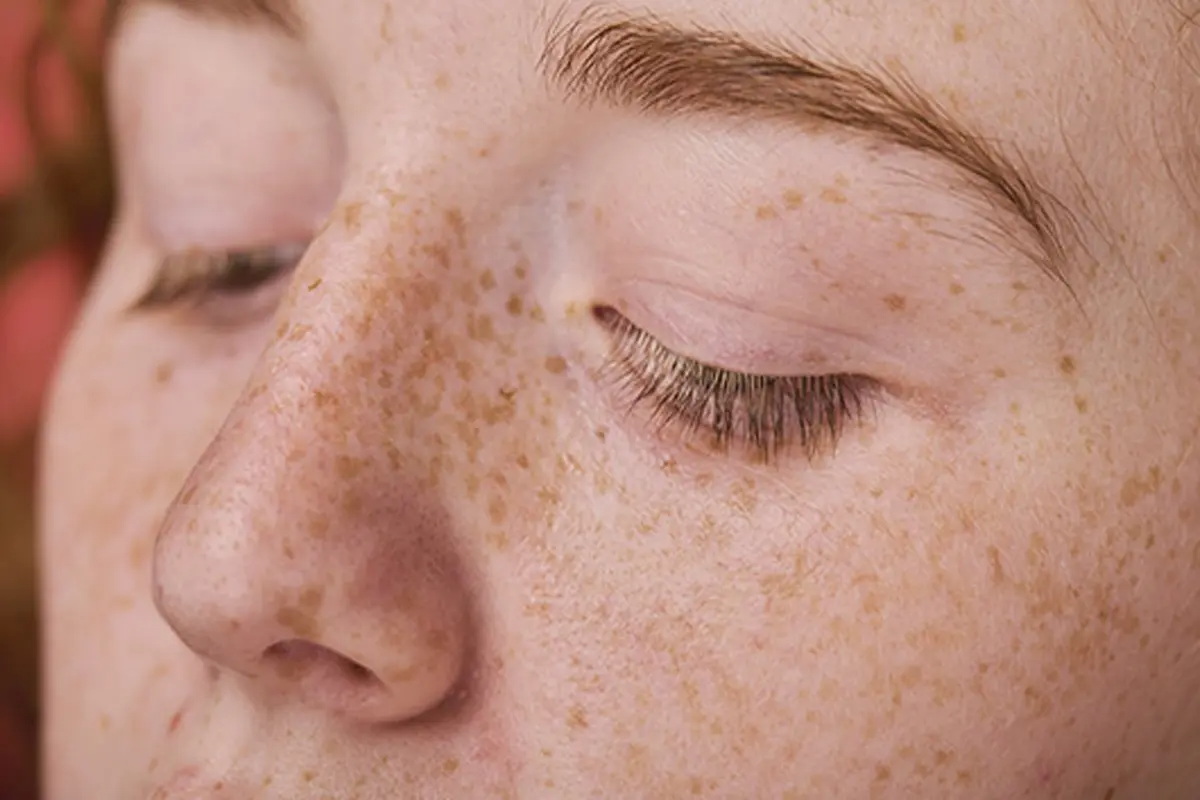 Close-up view of light brown freckles on skin, classified as light blemishes.