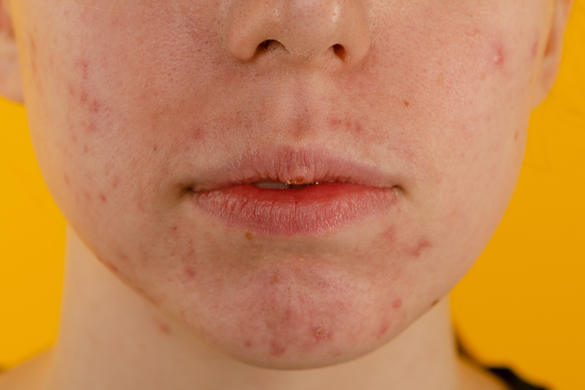 Close-up view of red spots on skin, indicating acne pigmentation or redness.