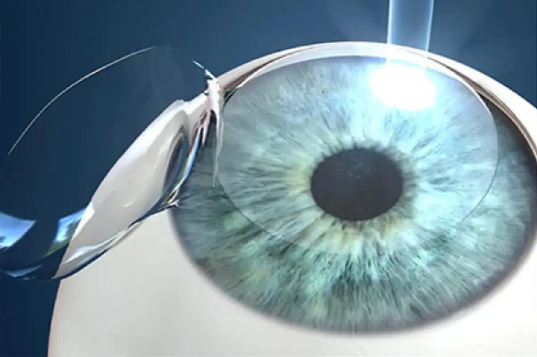 Lasik in Korea Preisführer: Kosten, Sicherheit und was Sie erwartet