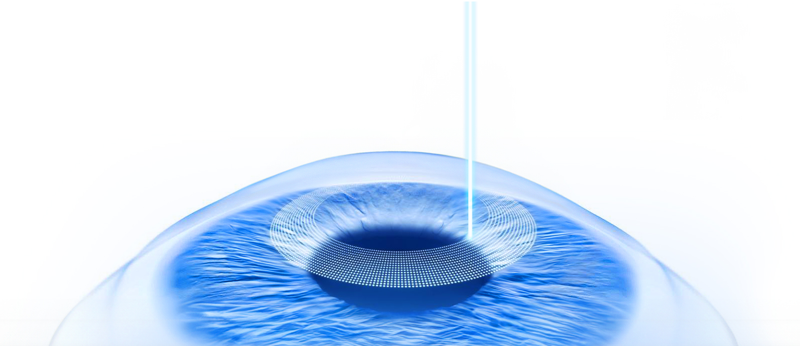 图示展示了眼科雷射手术的原理，强调对人体角膜的精确调整，以校正老花眼的视觉问题。