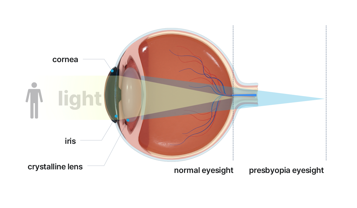 展示人工晶体在眼球内的植入位置以及其支持老花眼矫正的流程，进一步说明手术步骤。