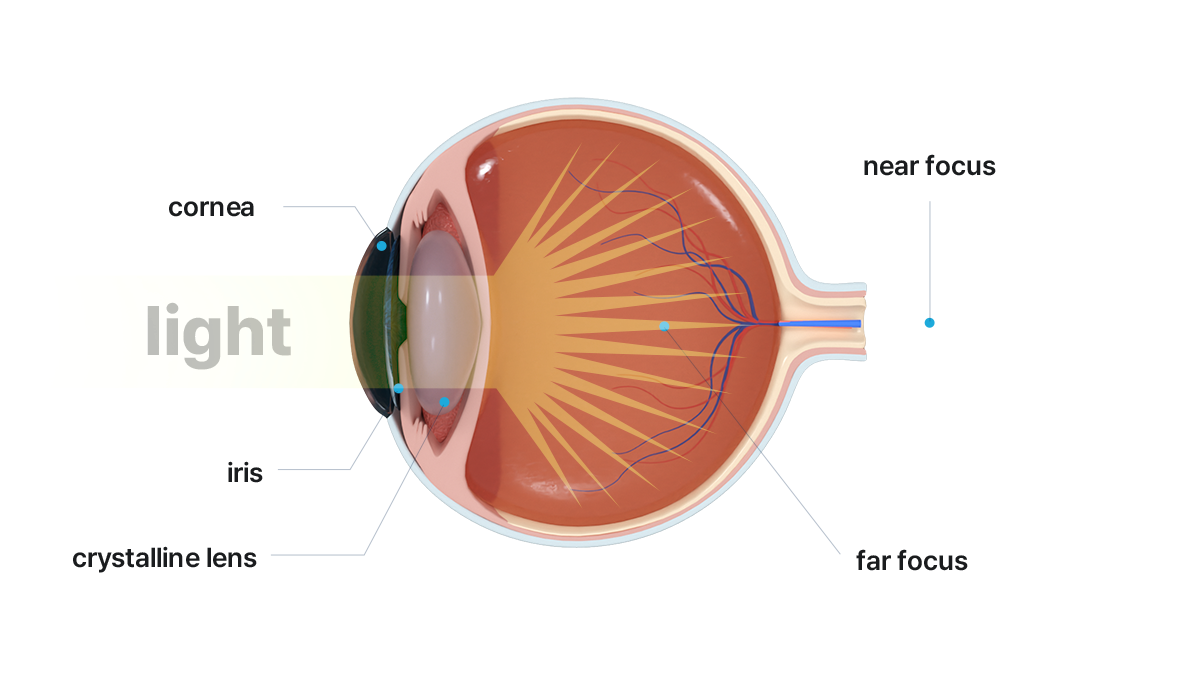 示意图显示了多焦点人工水晶体的结构及其功能，旨在帮助解决多种距离的视力问题。