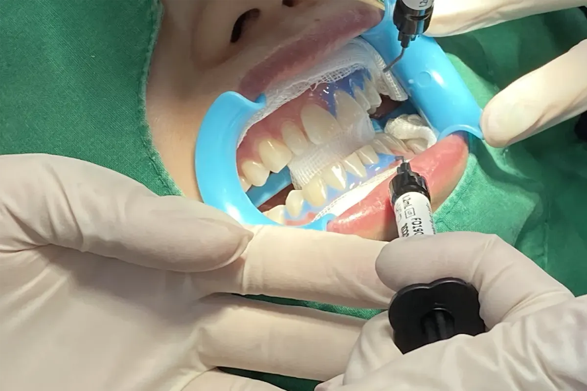 韓國牙齒美白 韓國漂牙 韓國牙齒美白療程 韓國牙科 韓國牙醫 韓國美白牙齒 韓國牙齒護理 韓國牙齒保健 韓國美容 瓷牙貼片 陶瓷牙齒貼片 藍光美白 藍光漂牙 韓國牙科診所推薦 2026價錢 邊間韓國牙科好 韓國牙齒美白有咩好