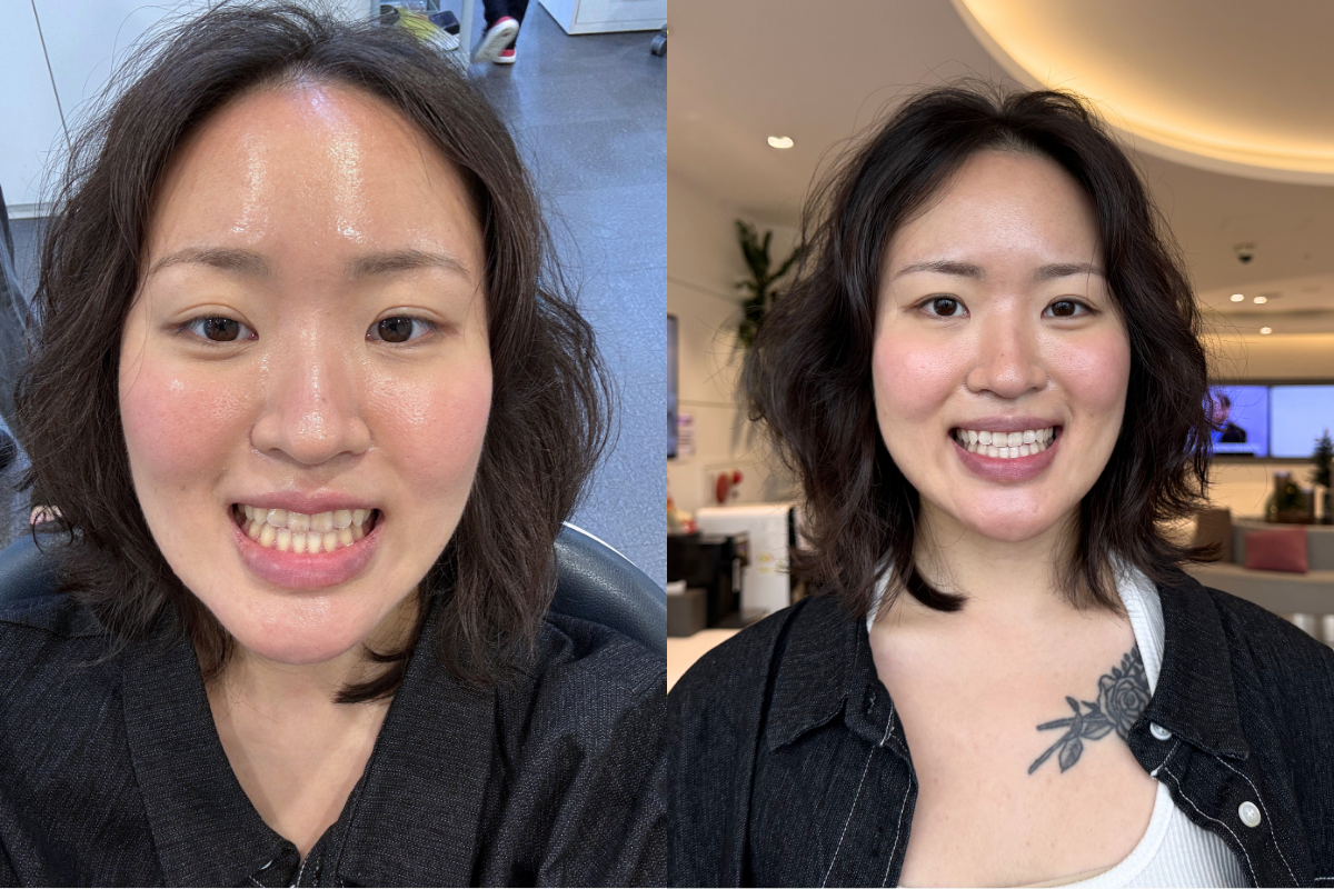 韓國牙齒美白 韓國漂牙 韓國牙齒美白療程 韓國牙科 韓國牙醫 韓國美白牙齒 韓國牙齒護理 韓國牙齒保健 韓國美容 瓷牙貼片 陶瓷牙齒貼片 藍光美白 藍光漂牙 韓國牙科診所推薦 2026價錢 邊間韓國牙科好 韓國牙齒美白有咩好