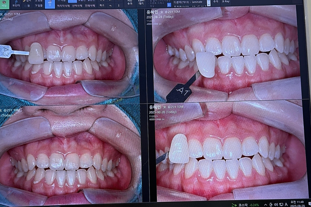 韓國牙齒美白 韓國漂牙 韓國牙齒美白療程 韓國牙科 韓國牙醫 韓國美白牙齒 韓國牙齒護理 韓國牙齒保健 韓國美容 瓷牙貼片 陶瓷牙齒貼片 藍光美白 藍光漂牙 韓國牙科診所推薦 2026價錢 邊間韓國牙科好 韓國牙齒美白有咩好