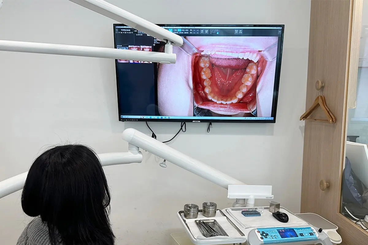 韓國牙齒美白 韓國牙科 推薦 貼片