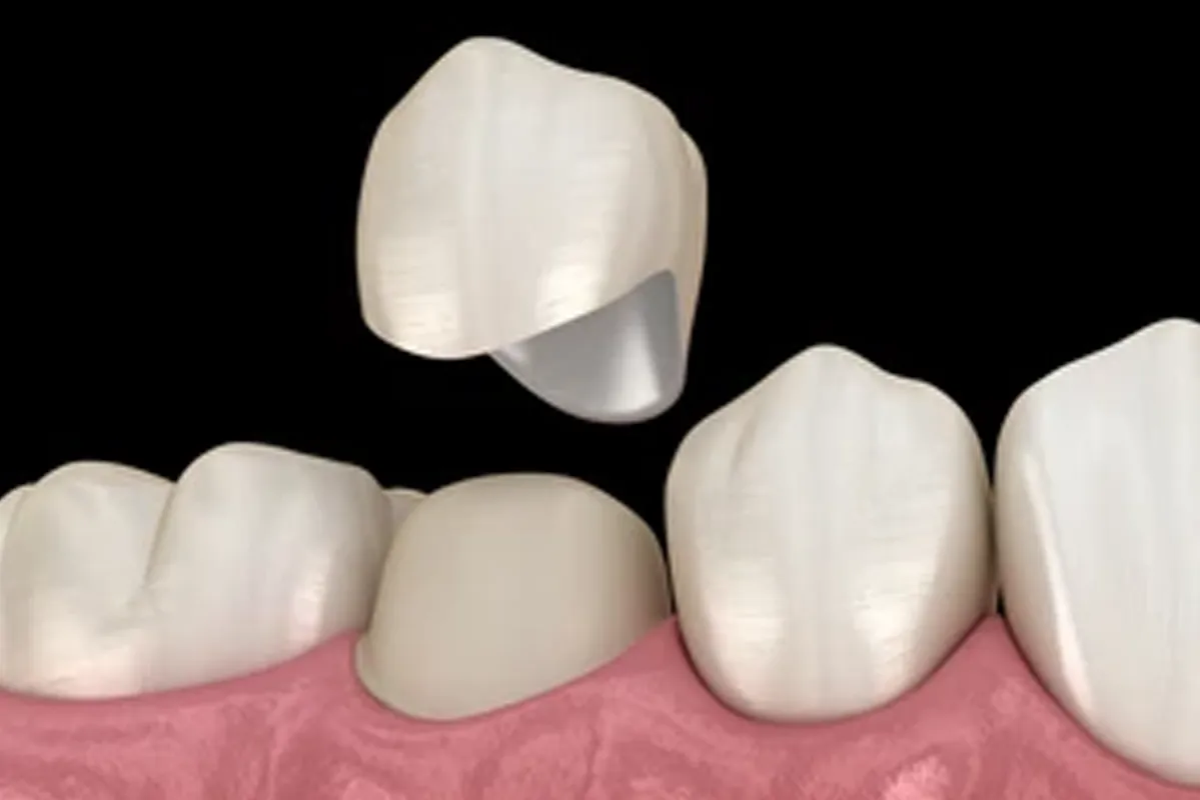 韓國牙齒美白 韓國漂牙 韓國牙齒美白療程 韓國牙科 韓國牙醫 韓國美白牙齒 韓國牙齒護理 韓國牙齒保健 韓國美容 瓷牙貼片 陶瓷牙齒貼片 藍光美白 藍光漂牙 韓國牙科診所推薦 2026價錢 邊間韓國牙科好 韓國牙齒美白有咩好