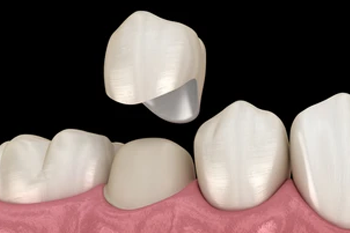 韓國牙齒美白 韓國牙科 推薦 貼片