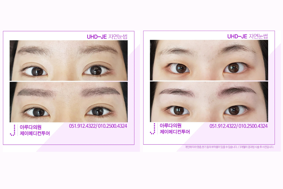 Semi-permanent eyebrow treatment at Lian Medi Center in Busan