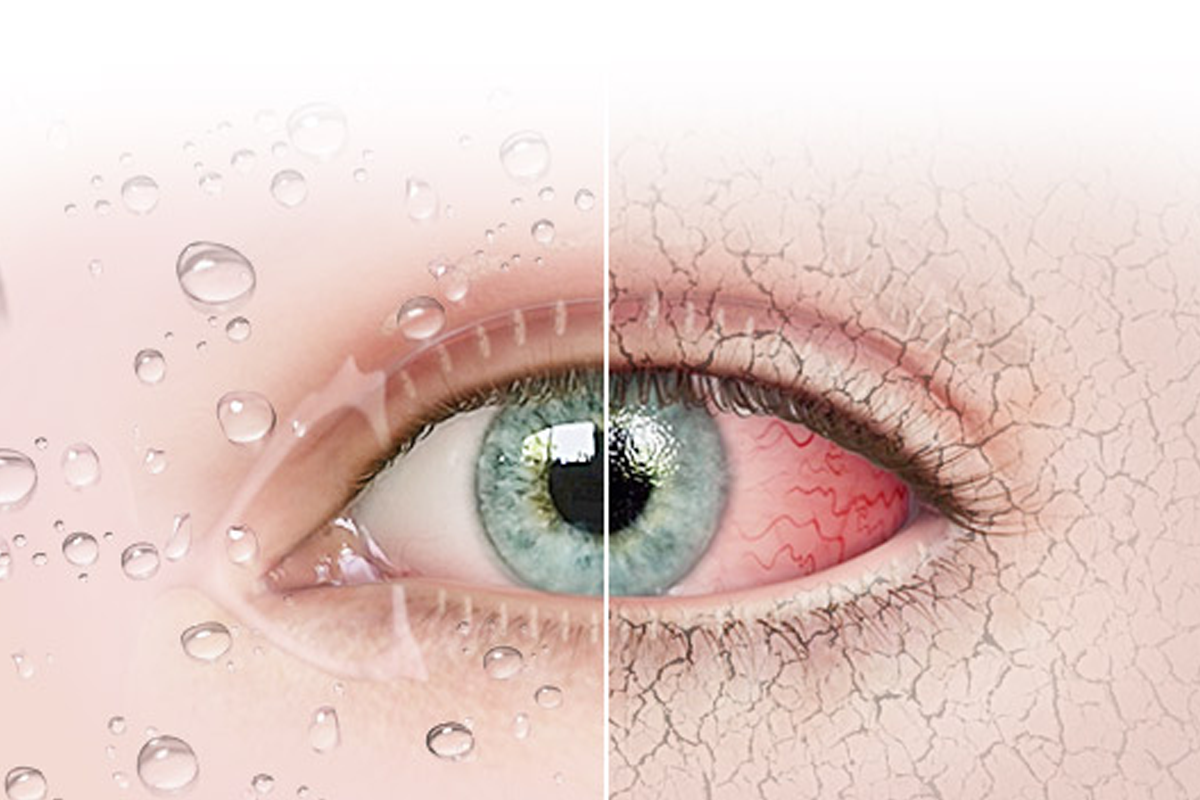 韓國眼睛 近視雷射 後遺症整理