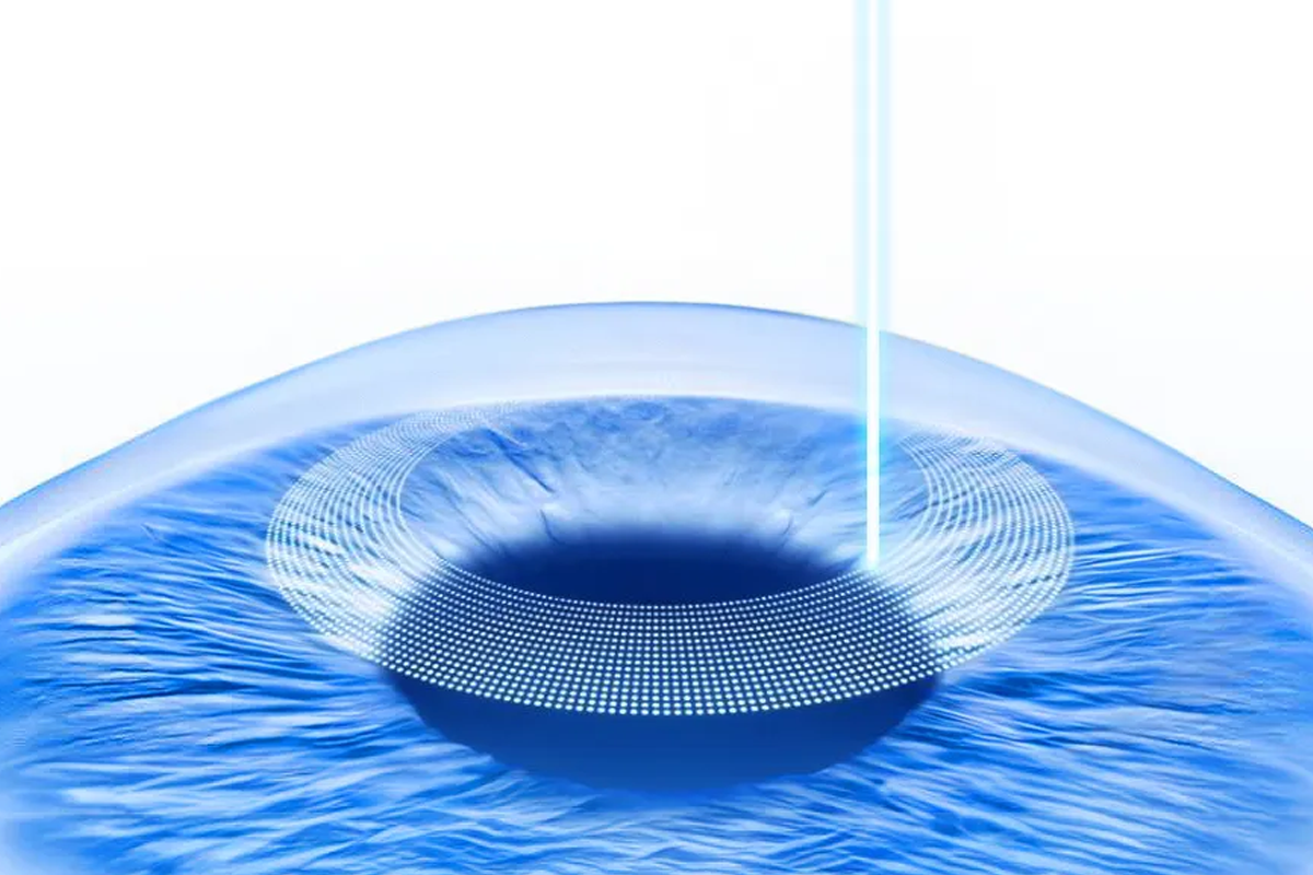 韓國近視雷射 乾眼 後遺症 痊癒