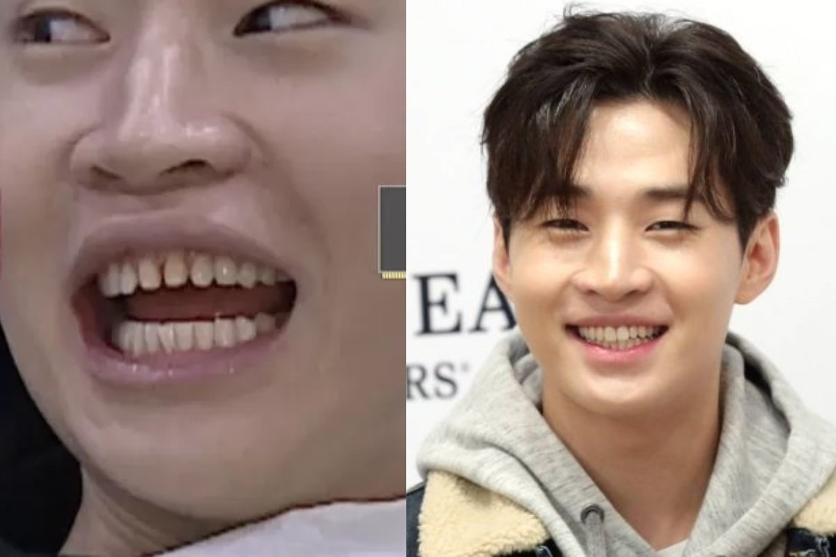 韓國牙齒護理 韓國牙科 韓國牙醫 韓國美白牙齒 陶瓷牙齒貼片 藍光美白 零磨牙陶瓷牙齒貼片 韓國牙齒清潔 韓國牙齒保健 韓國牙齒美白 韓國牙齒矯正 首爾牙科 首爾牙科推薦