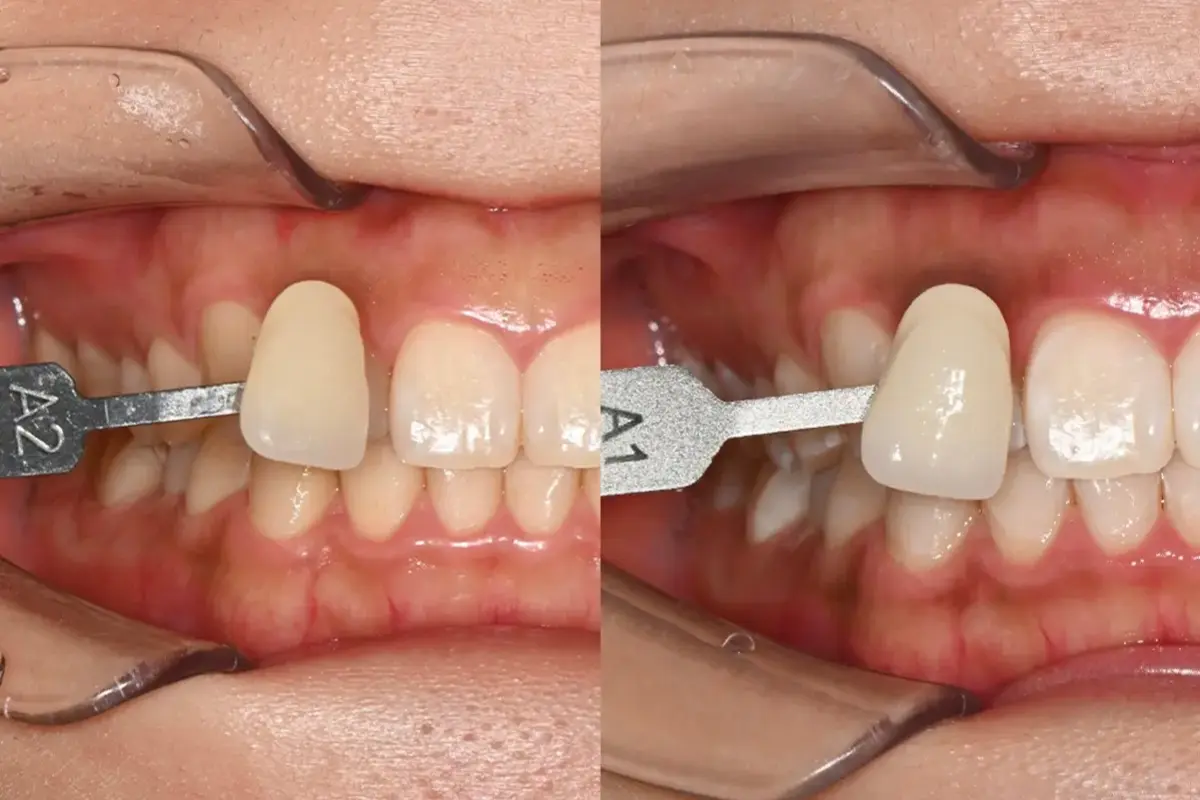 韓國牙齒護理 韓國牙科 韓國牙醫 韓國美白牙齒 陶瓷牙齒貼片 藍光美白 零磨牙陶瓷牙齒貼片 韓國牙齒清潔 韓國牙齒保健 韓國牙齒美白 韓國牙齒矯正 首爾牙科 首爾牙科推薦