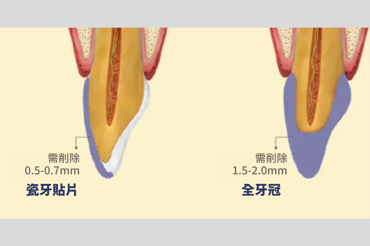 韓國瓷牙貼片 陶瓷牙齒貼片 零磨牙陶瓷牙齒貼片 原理 優點 韓國牙齒美容 韓國牙齒美白 韓國牙科推薦 韓國牙齒護理 韓國牙齒矯正 韓國牙齒貼片 韓國牙科診所推薦