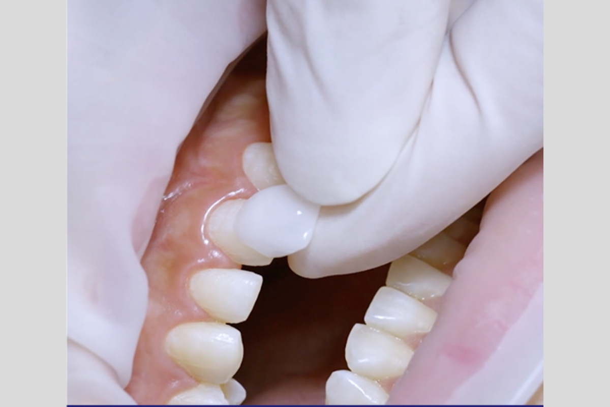 韓國牙齒美白 韓國漂牙 韓國牙齒美白療程 韓國牙科 韓國牙醫 韓國美白牙齒 韓國牙齒護理 韓國牙齒保健 韓國美容 瓷牙貼片 陶瓷牙齒貼片 藍光美白 藍光漂牙 韓國牙科診所推薦 價錢