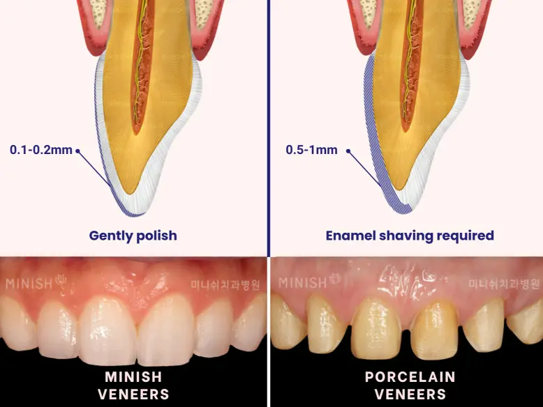 韓國牙齒美白 韓國漂牙 韓國牙齒美白療程 韓國牙科 韓國牙醫 韓國美白牙齒 韓國牙齒護理 韓國牙齒保健 韓國美容 瓷牙貼片 陶瓷牙齒貼片 藍光美白 藍光漂牙 韓國牙科診所推薦 價錢