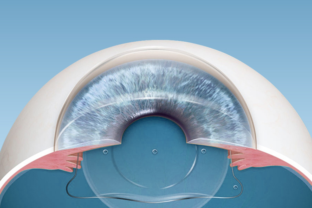 2026韓國SMILE雷射費用