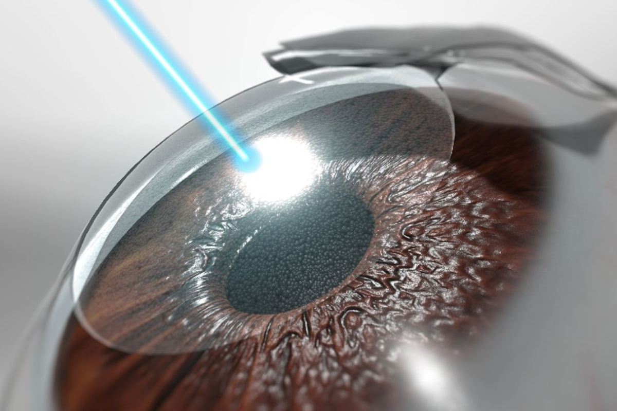 韓國 近視雷射2026價格