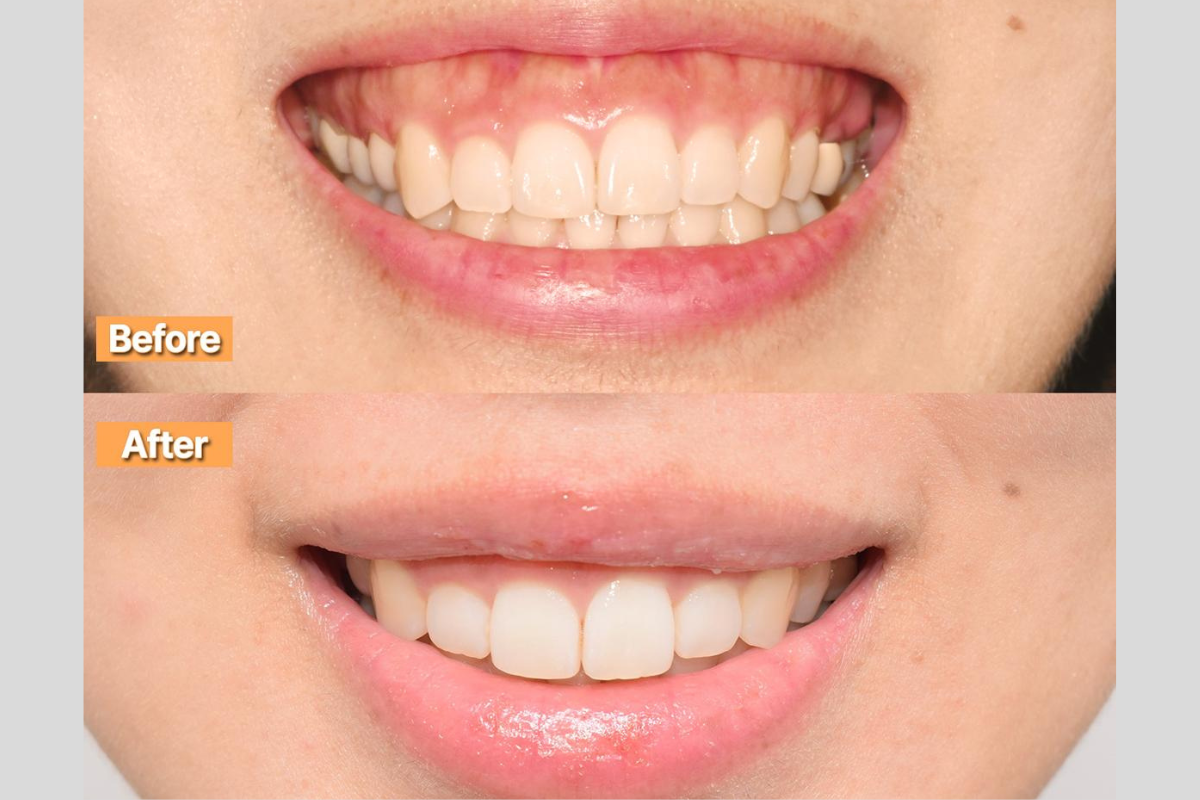 韓國牙科療程 韓國牙醫推薦 韓國牙齒美白 韓國牙齒矯正 韓國口腔健康 韓國牙齒護理 韓國牙科診所 韓國牙科技術 韓國牙科保健 韓國醫療旅遊 韓國漂牙