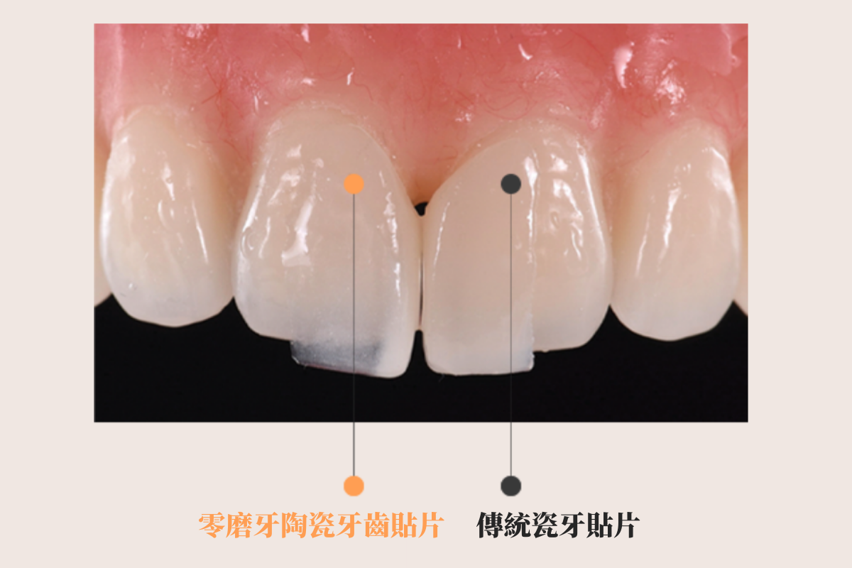 韓國瓷牙貼片 陶瓷牙齒貼片 零磨牙陶瓷牙齒貼片 原理 優點 韓國牙齒美容 韓國牙齒美白 韓國牙科推薦 韓國牙齒護理 韓國牙齒矯正 韓國牙齒貼片 韓國牙科診所推薦