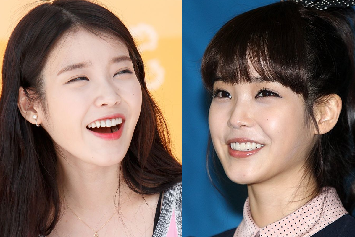 韓國瓷牙貼片 陶瓷牙齒貼片 零磨牙陶瓷牙齒貼片 原理 優點 韓國牙齒美容 韓國牙齒美白 韓國牙科推薦 韓國牙齒護理 韓國牙齒矯正 韓國牙齒貼片 韓國牙科診所推薦