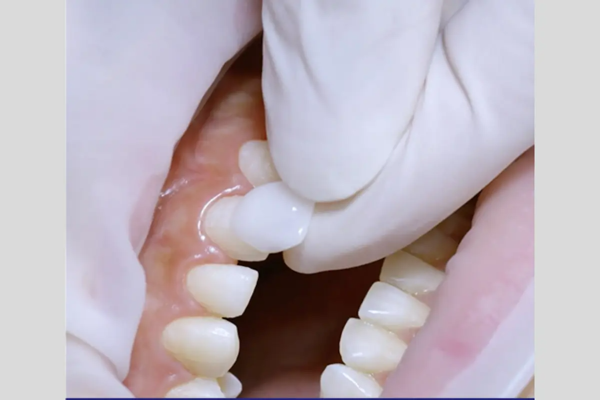 韓國瓷牙貼片 陶瓷牙齒貼片 零磨牙陶瓷牙齒貼片 原理 優點 韓國牙齒美容 韓國牙齒美白 韓國牙科推薦 韓國牙齒護理 韓國牙齒矯正 韓國牙齒貼片 韓國牙科診所推薦