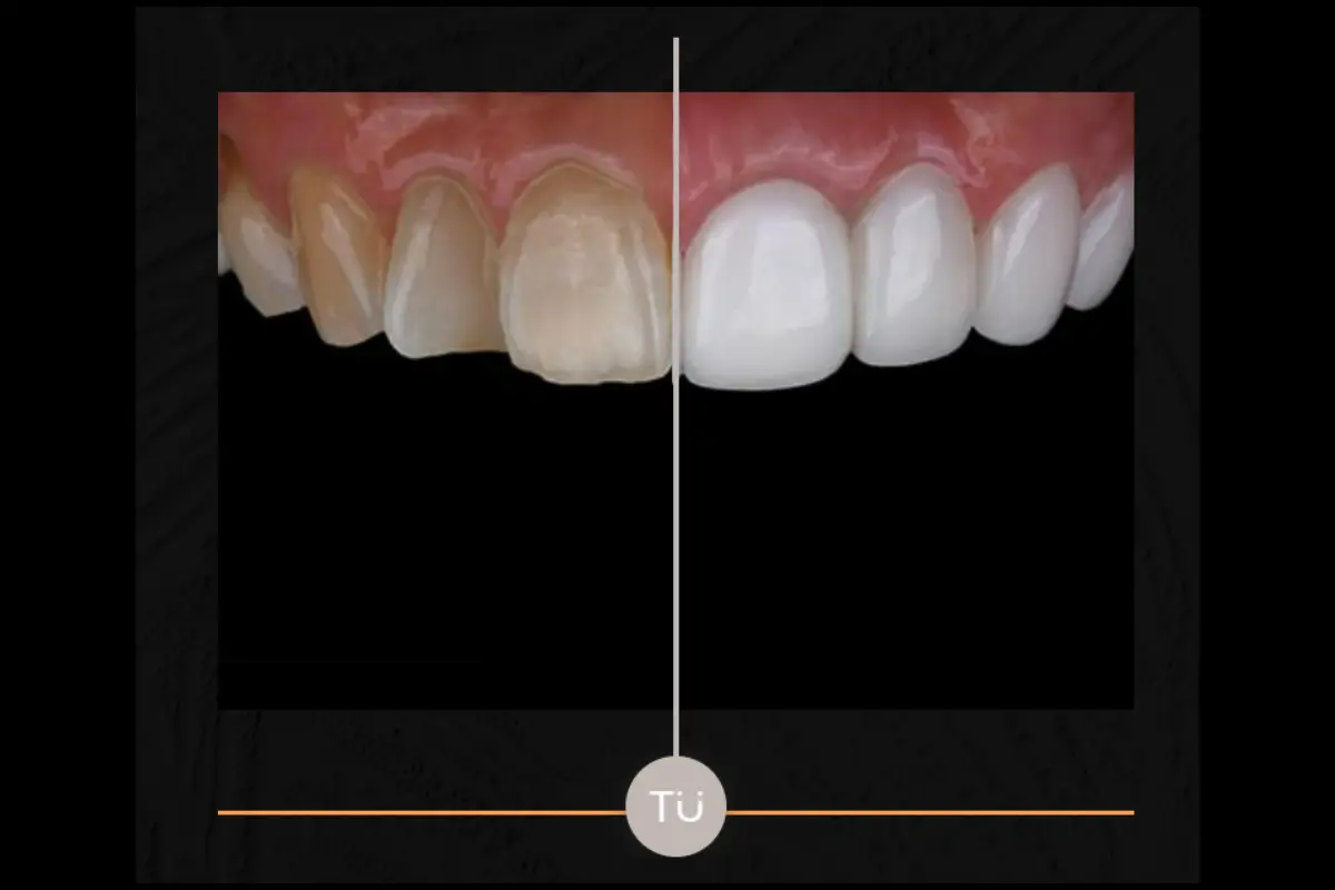 韓國瓷牙貼片 陶瓷牙齒貼片 零磨牙陶瓷牙齒貼片 原理 優點 韓國牙齒美容 韓國牙齒美白 韓國牙科推薦 韓國牙齒護理 韓國牙齒矯正 韓國牙齒貼片 韓國牙科診所推薦