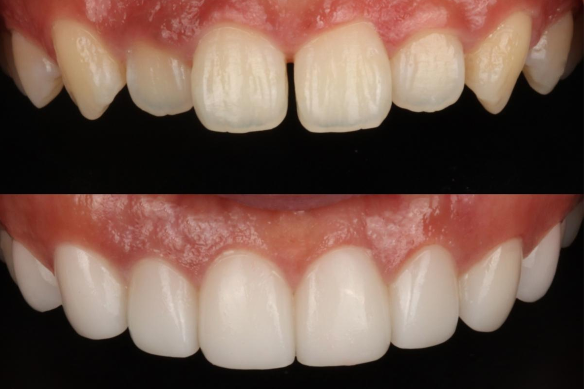 BLANCHE牙科 韓國牙科 首爾牙科 江南牙科推薦 韓國牙齒美白療程 韓國洗牙 零磨牙瓷牙貼片 牙齒貼片 블랑쉬치과