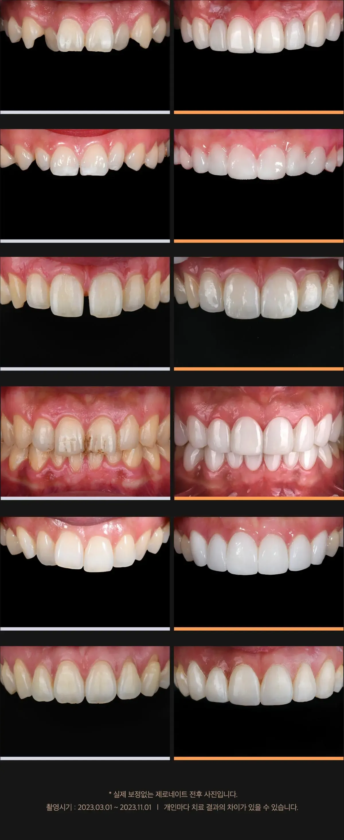 韓國瓷牙貼片 陶瓷牙齒貼片 零磨牙陶瓷牙齒貼片 原理 優點 韓國牙齒美容 韓國牙齒美白 韓國牙科推薦 韓國牙齒護理 韓國牙齒矯正 韓國牙齒貼片 韓國牙科診所推薦