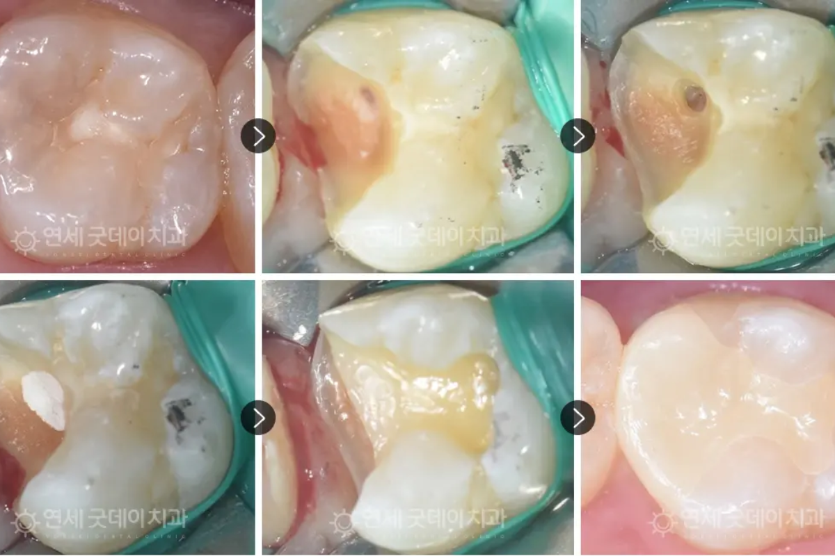 韓國牙科 香港牙科 牙齒美白 牙齒矯正 牙科療程 韓國牙科價錢 香港牙科價錢 韓國醫療 韓國牙科推薦 韓國補牙 香港補牙