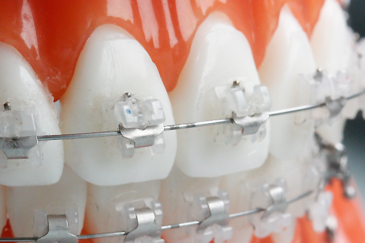 韓國牙科 香港牙科 牙齒美白 牙齒矯正 牙科療程 韓國牙科價錢 香港牙科價錢 韓國醫療 韓國牙科推薦 韓國箍牙 香港箍牙