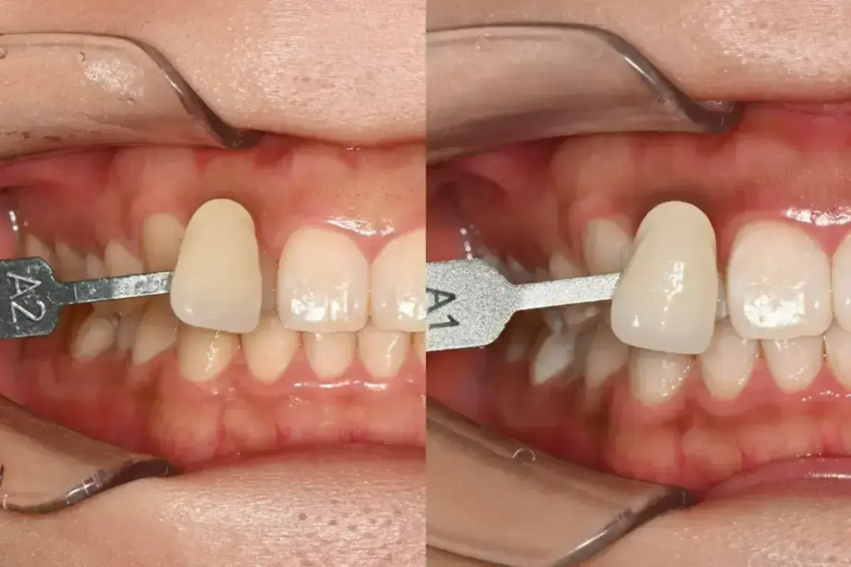 Korean dentistry dental procedures dental clinic recommendations Korean teeth whitening Korean dental cleaning dental checkup Korean fillings Korean dentists dental care Korean dental cosmetics Korean porcelain veneers Korean front-tooth veneers recommended Korean dental clinics Korean dental prices