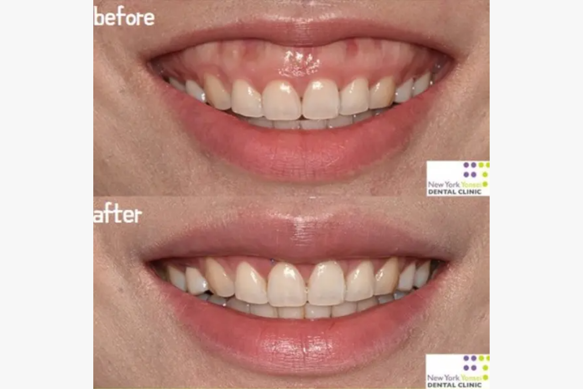 牙齒微笑線 微笑線 牙科 牙科診所 箍牙 門牙貼片 瓷牙貼片 牙齒美白 漂牙 牙齦美白 嘴唇重置術 牙齦微整形 韓國牙科 韓國牙科診所推薦 價錢