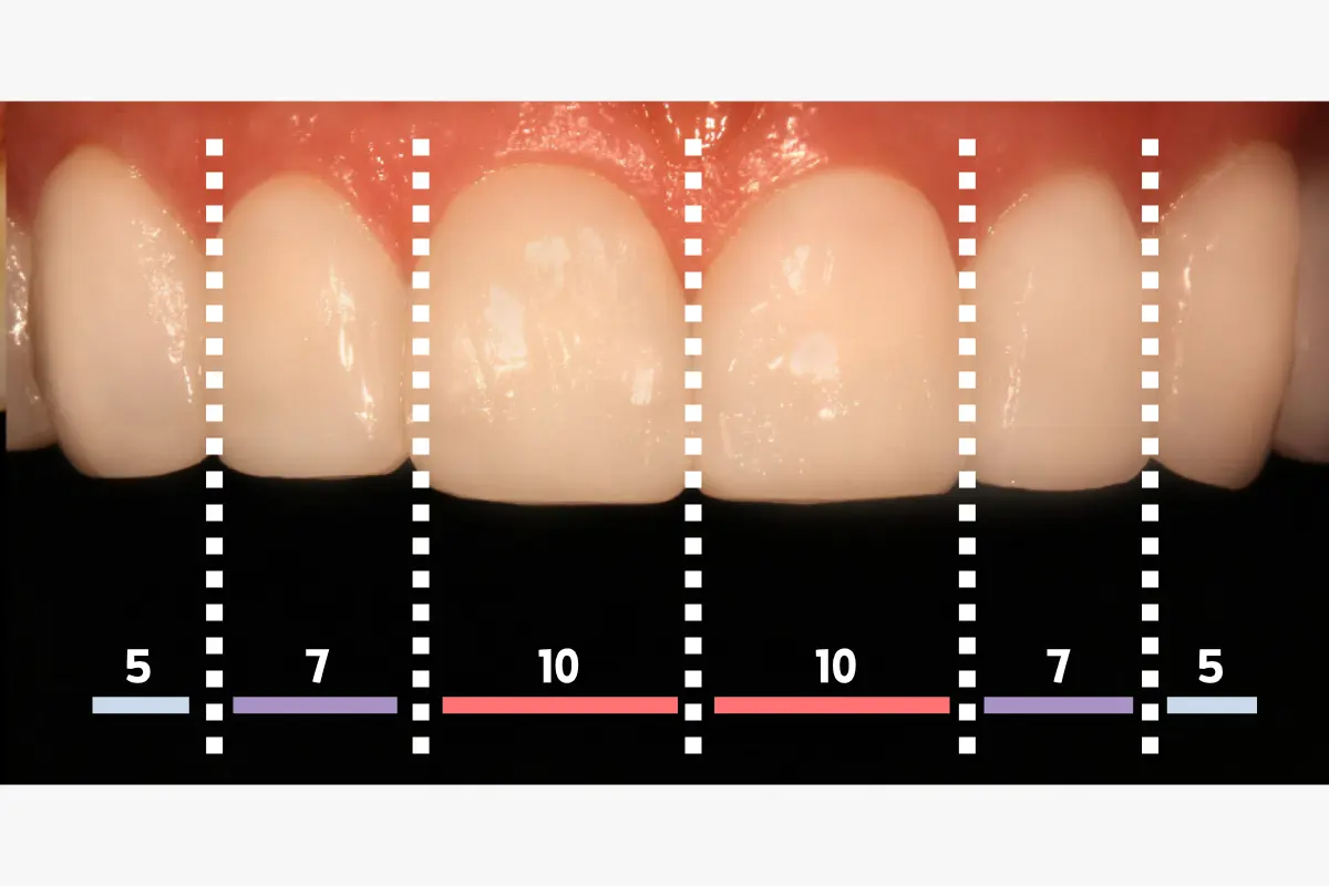 牙齒微笑線 微笑線 牙科 牙科診所 箍牙 門牙貼片 瓷牙貼片 牙齒美白 漂牙 牙齦美白 嘴唇重置術 牙齦微整形 韓國牙科 韓國牙科診所推薦 價錢